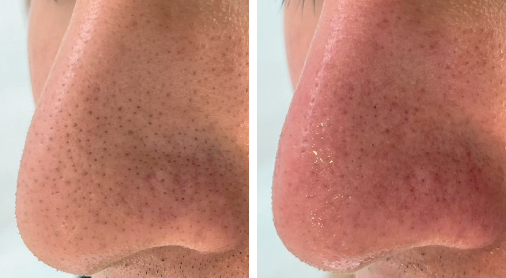 毛穴洗浄・毛穴エクストラクション