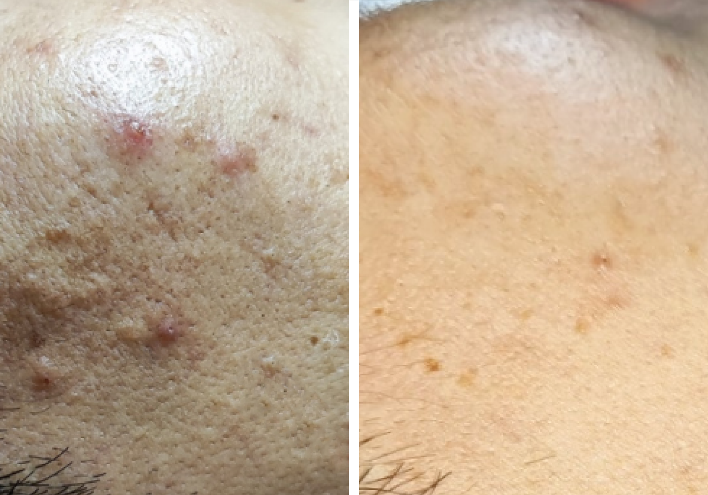 ハーブピーリングのビフォアー・アフター写真No.1