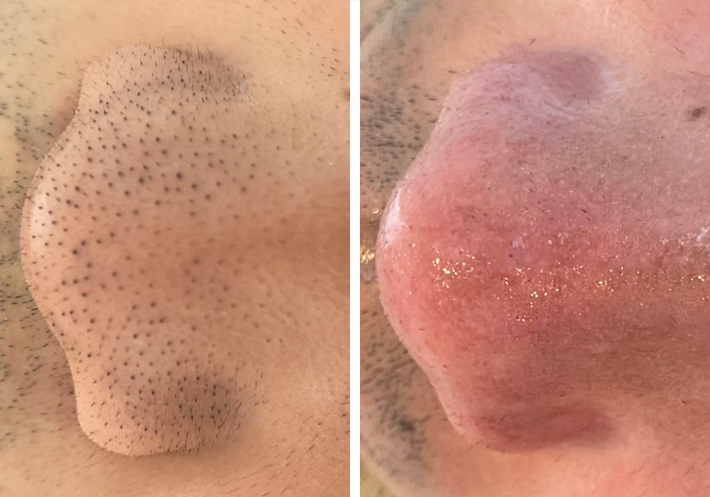 毛穴洗浄のビフォアー・アフター写真No.1