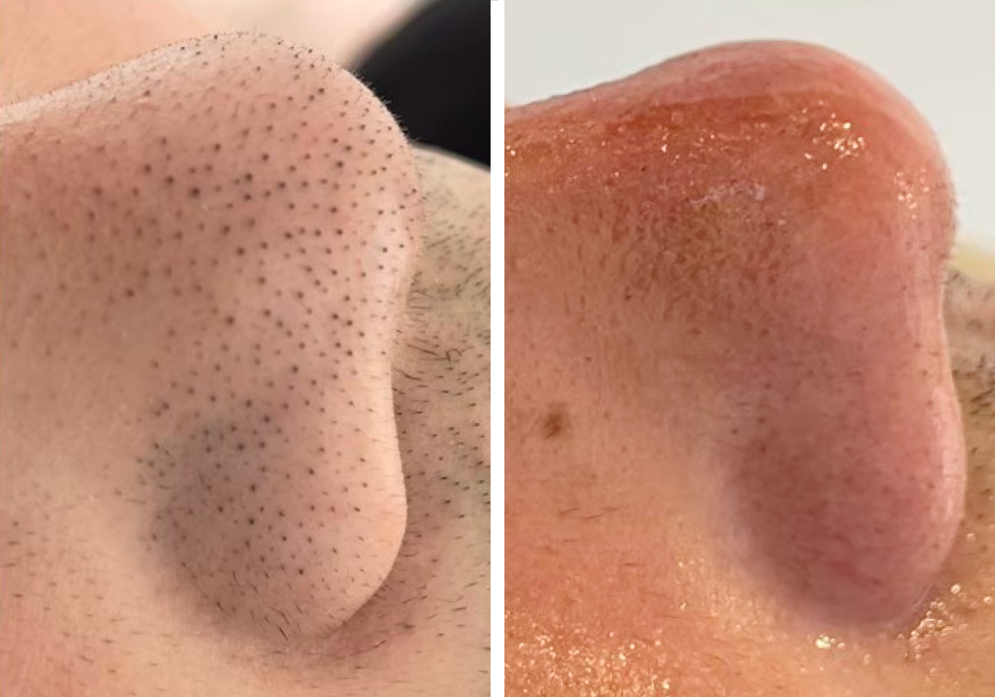 毛穴洗浄のビフォアー・アフター写真No.2