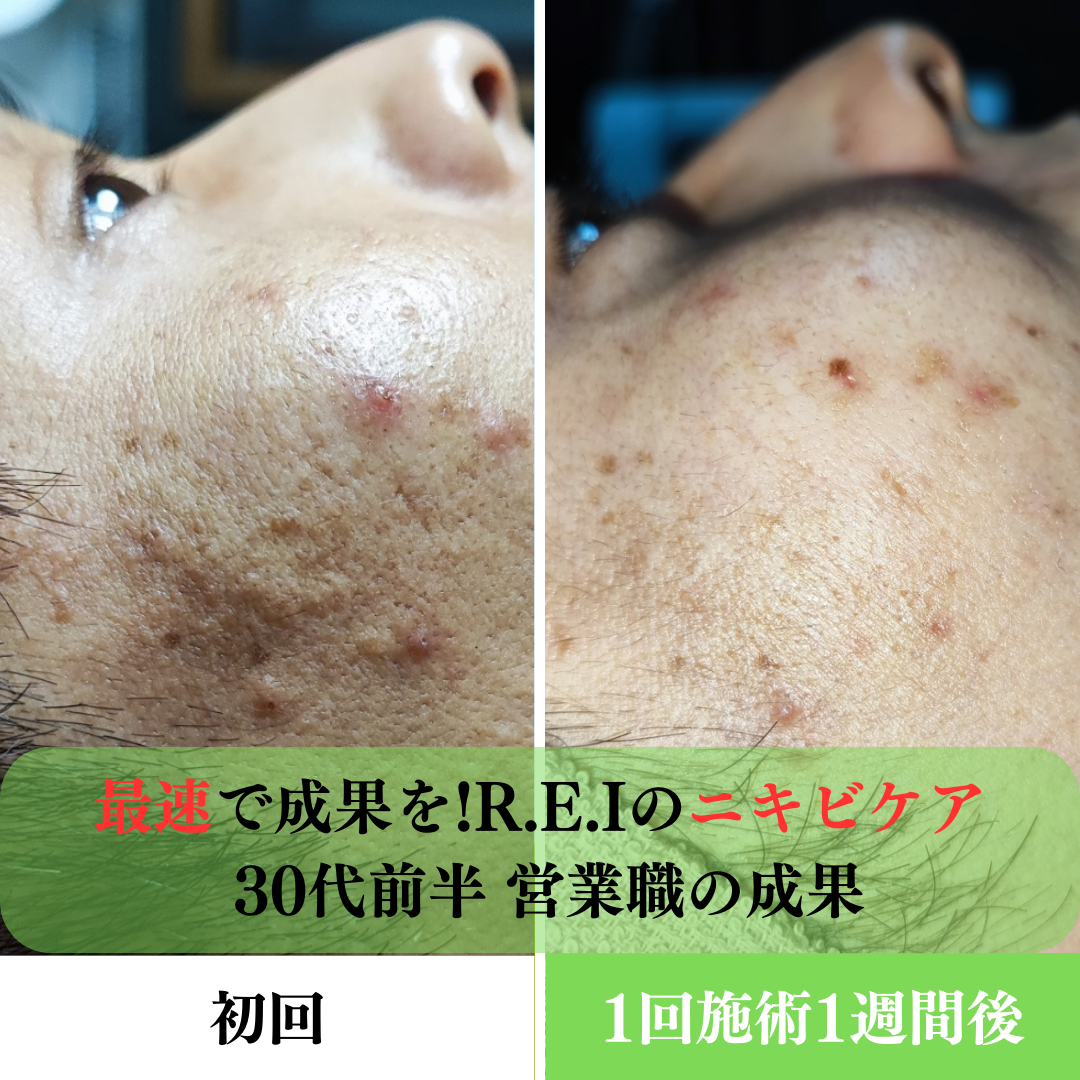 ハーブピーリング1回目の効果