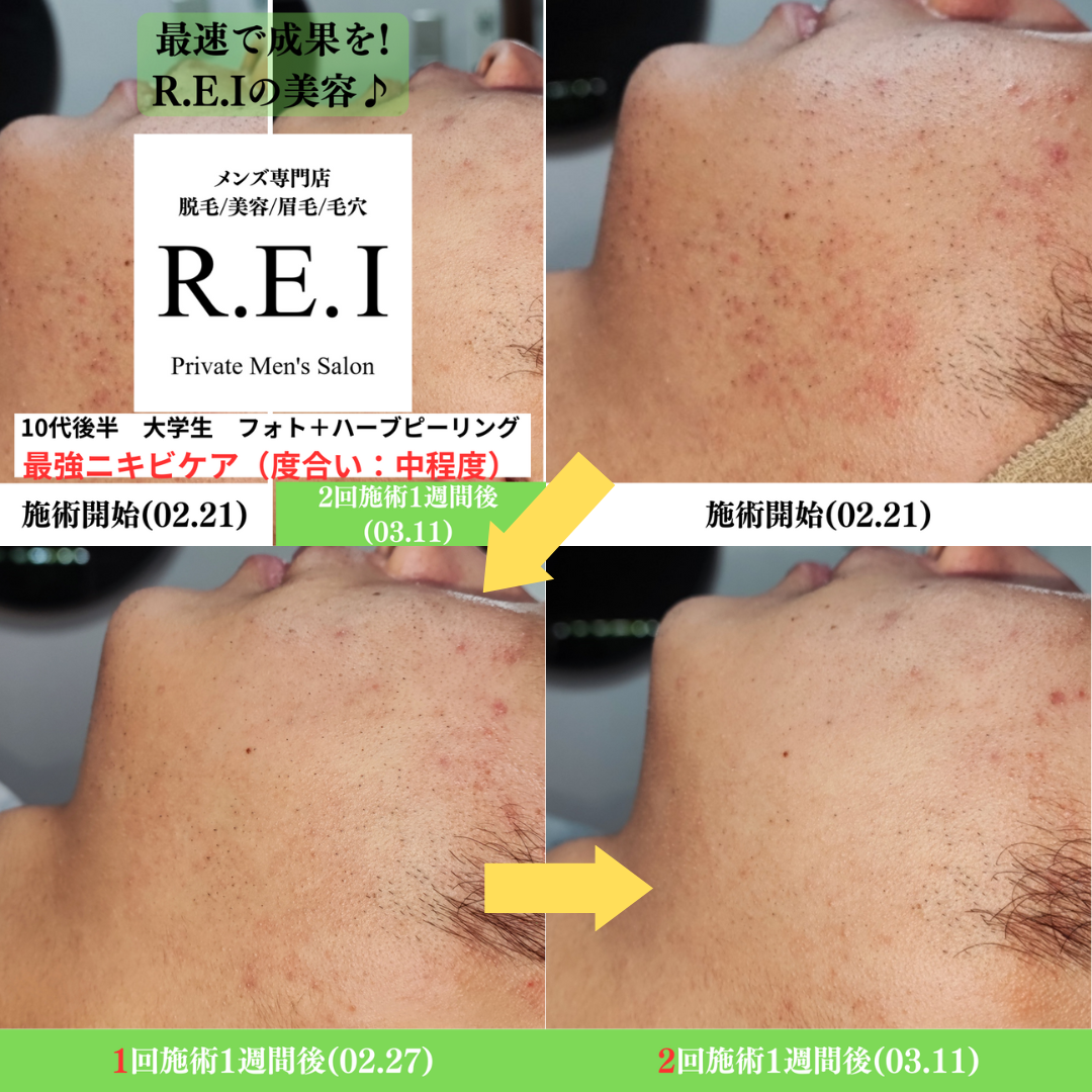 ハーブピーリング＋光フォトフェイシャルの施術効果