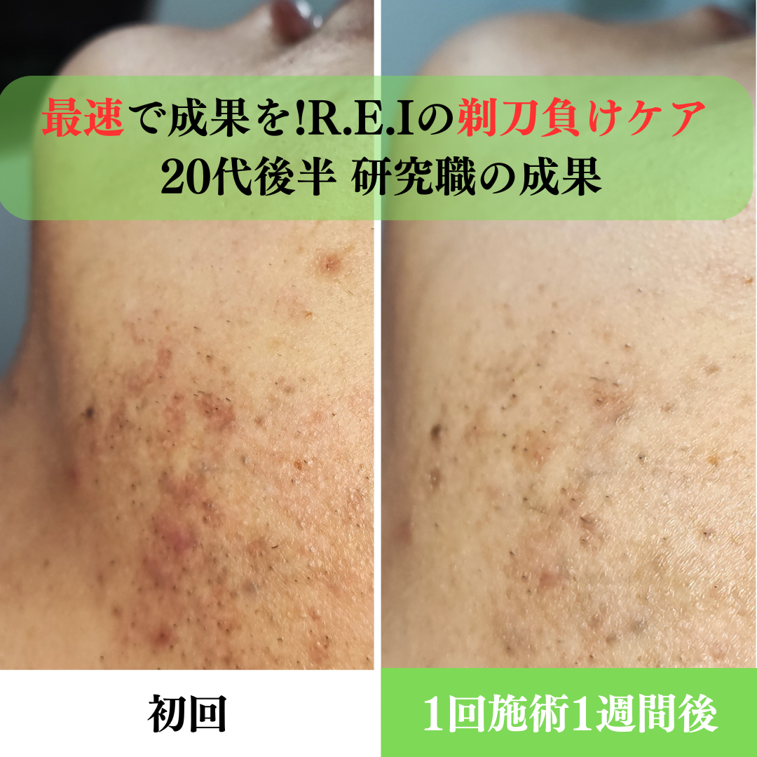 ハーブピーリングで乾燥肌・ニキビ肌改善