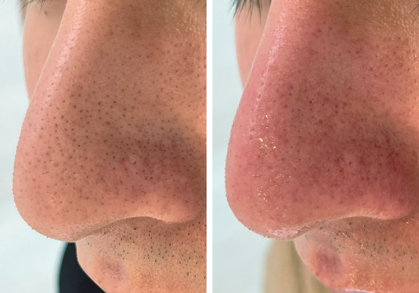 メンズ毛穴洗浄の施術写真