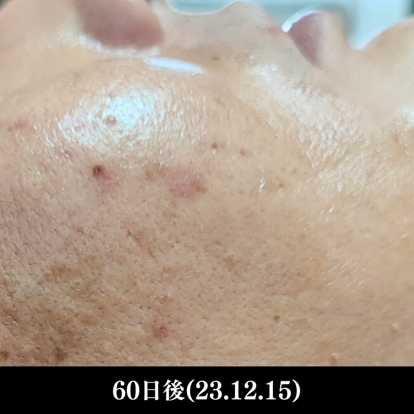 メンズ 脱毛後写真NO.1(ほほ)