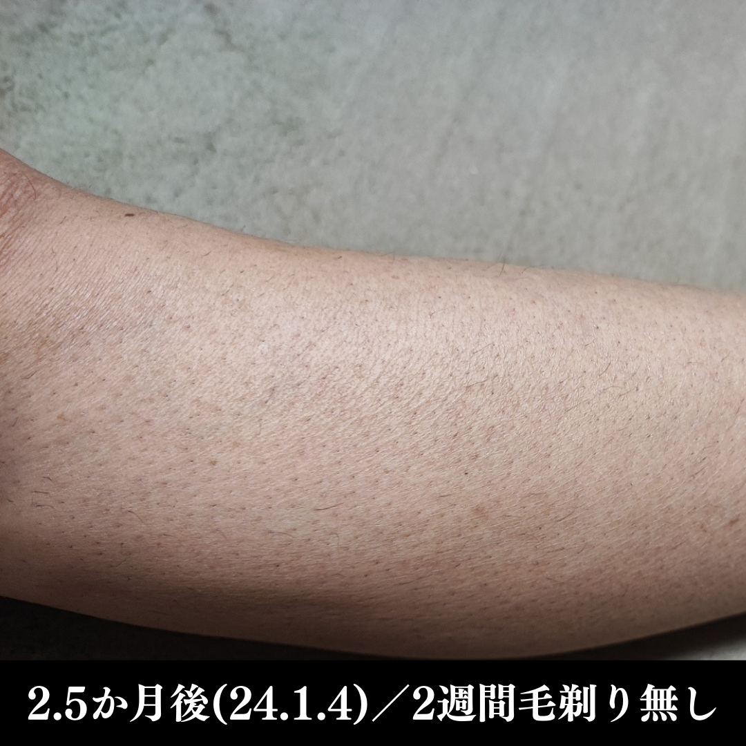 メンズ両足脱毛後