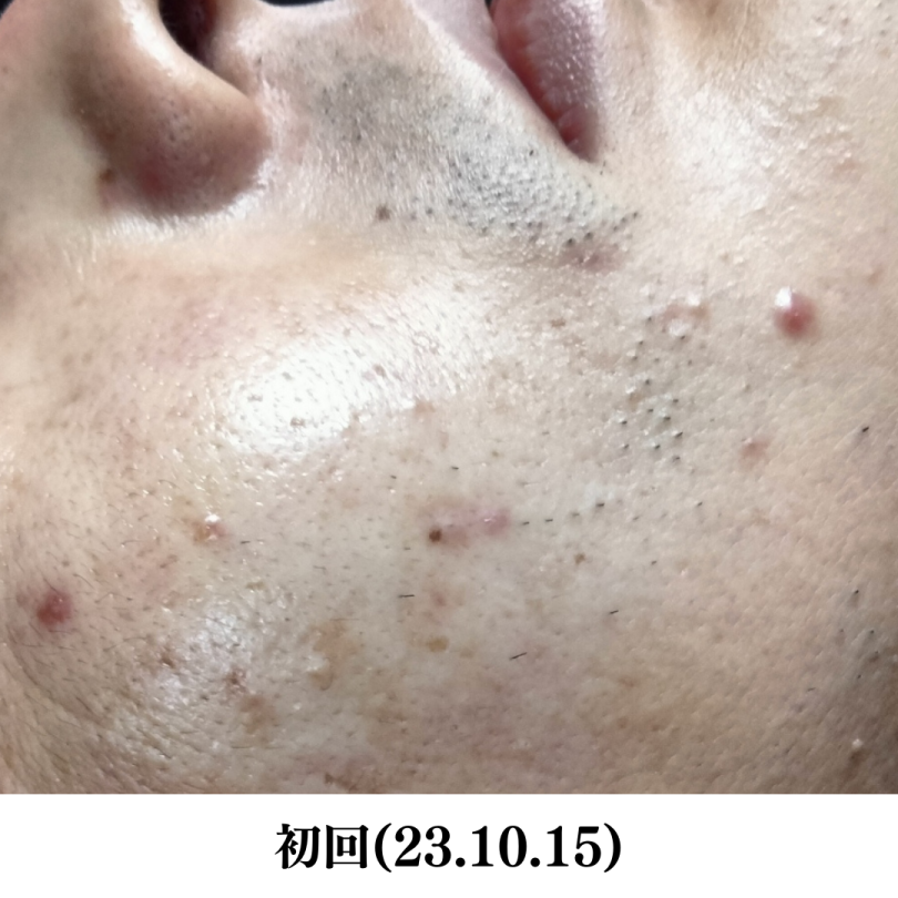 メンズ ヒゲ脱毛前写真NO.1(ほほ)