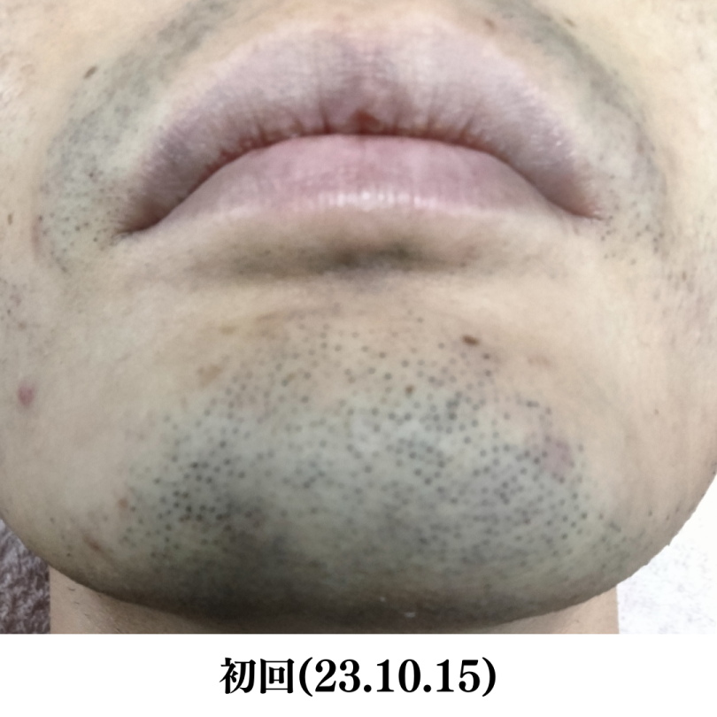 メンズ ヒゲ脱毛前写真NO.1（アゴ）