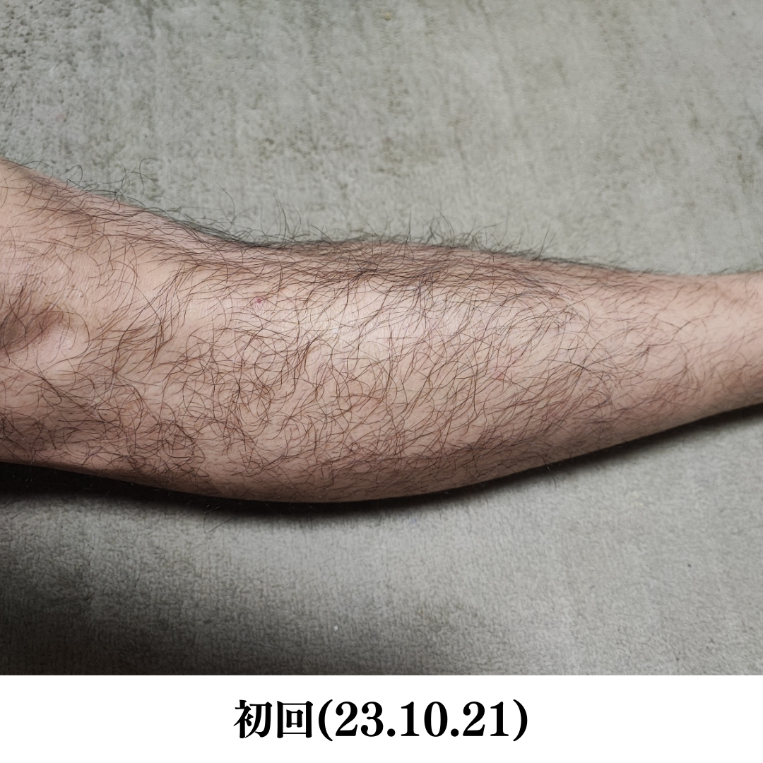 メンズ両足脱毛前