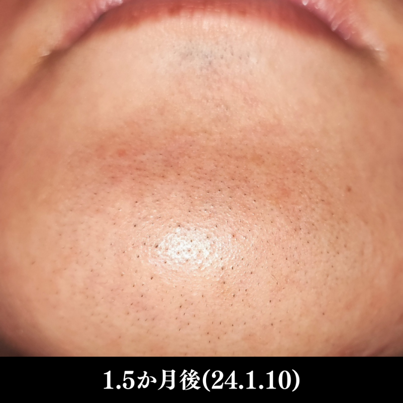 ヒゲ脱毛（大学生）後写真NO.1