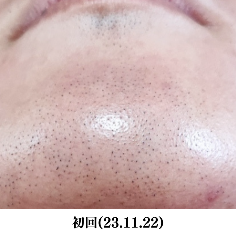 ヒゲ脱毛（大学生）前写真NO.1