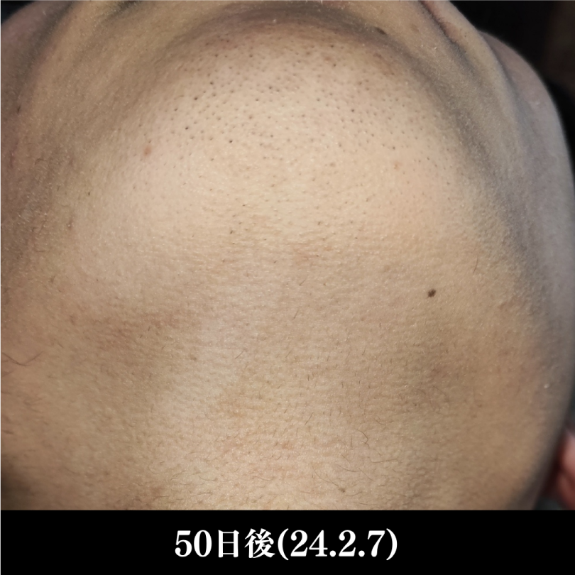 ヒゲ脱毛（高校生）後写真NO.2