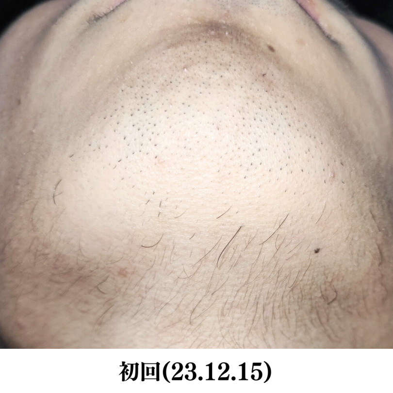 ヒゲ脱毛（高校生）前写真NO.2